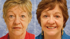 Face Lift and Upper & Lower Bleph       